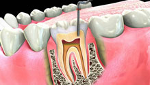 rct Root Canal Therapy in Rohtak – Pain-free dental treatment by expert dentists at Dr. Gogia’s Super Specialty Dental Care Centre