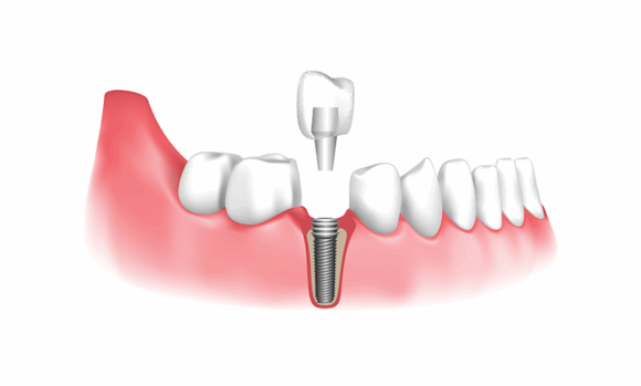 Dental Implants  : A Permanent Solution for Missing Teeth