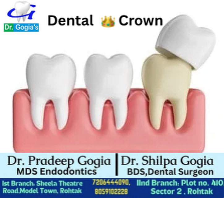 Dental Crowns Solutions in Rohtak by Dr. Gogia’s Clinic Protect Damaged Teeth ,improve function and regain confidence with expert dental care today