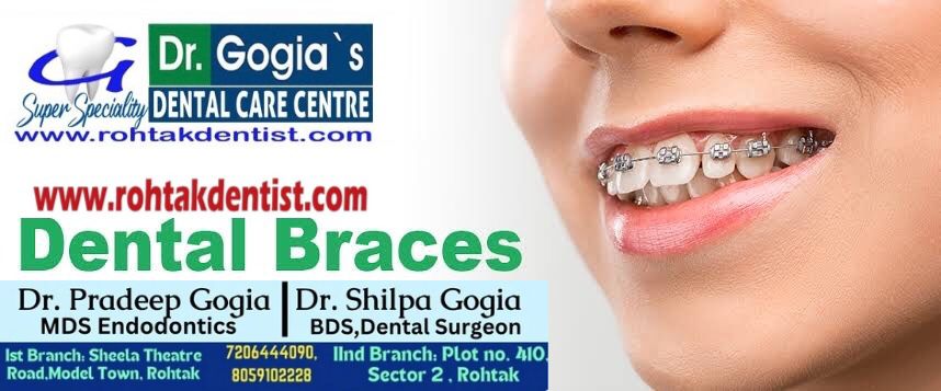 Dental braces for kids and adults at Dr. Gogia’s Dental Clinic, Rohtak