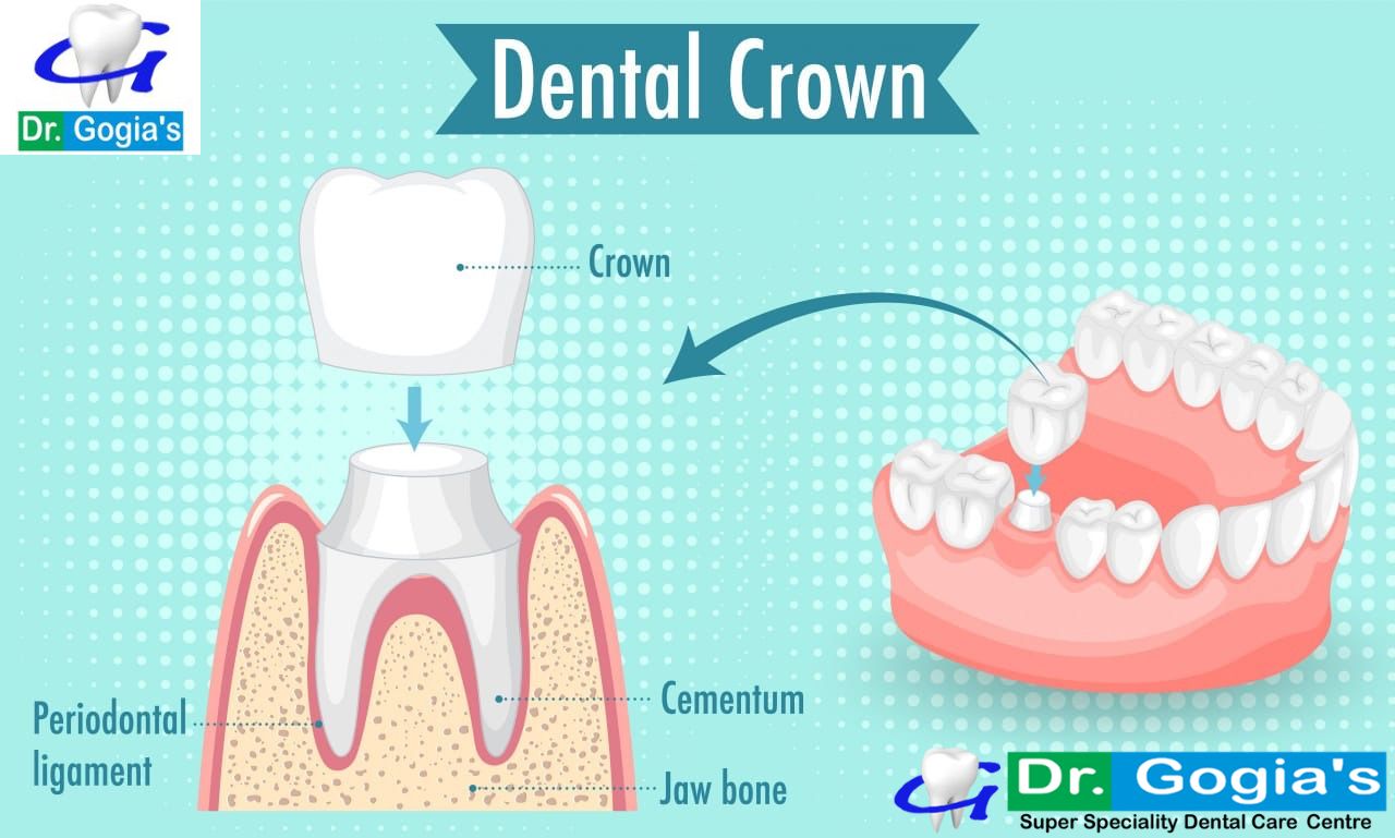 Dental Crown treatment for restoring tooth strength and smile