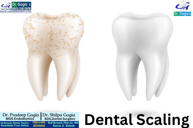Daant Ki Safai Karwana Rohtak – Expert Teeth Cleaning & Polishing by Dr. Gogia