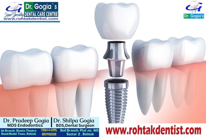Dental Implant procedure at Dr. Gogia’s Super Specialty Dental Care Centre