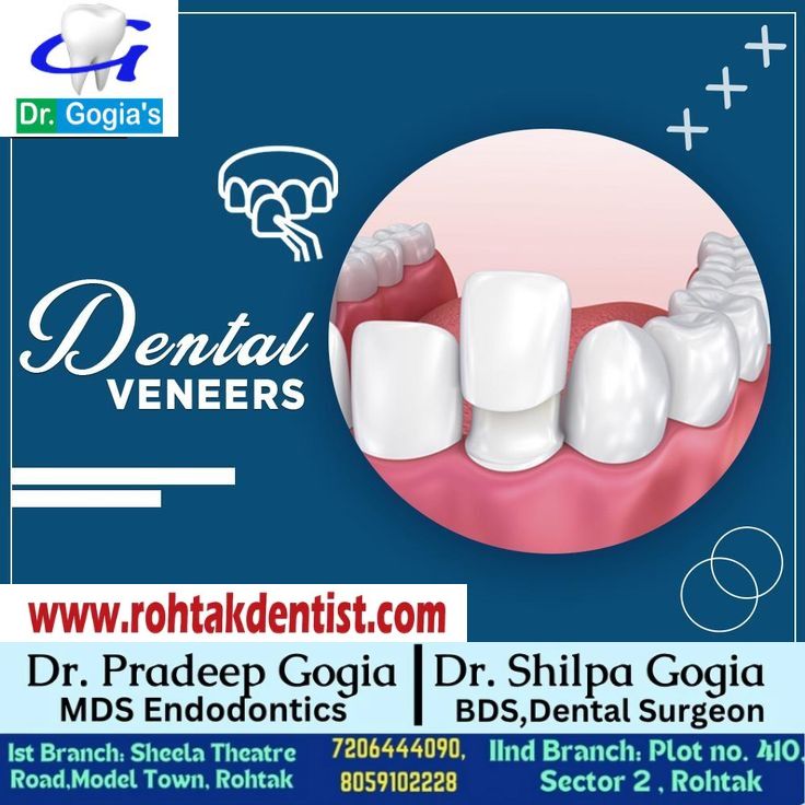 Dental Veneers treatment at Dr. Gogia’s Super Specialty Dental Care Centre