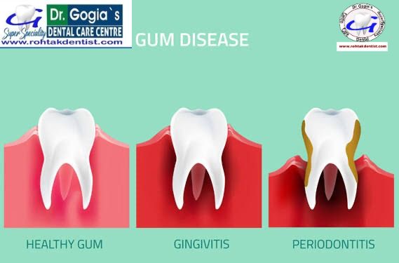 Patient receiving treatment for gum disease at Dr. Gogia's Super Specialty Dental Care Centre, Rohtak.