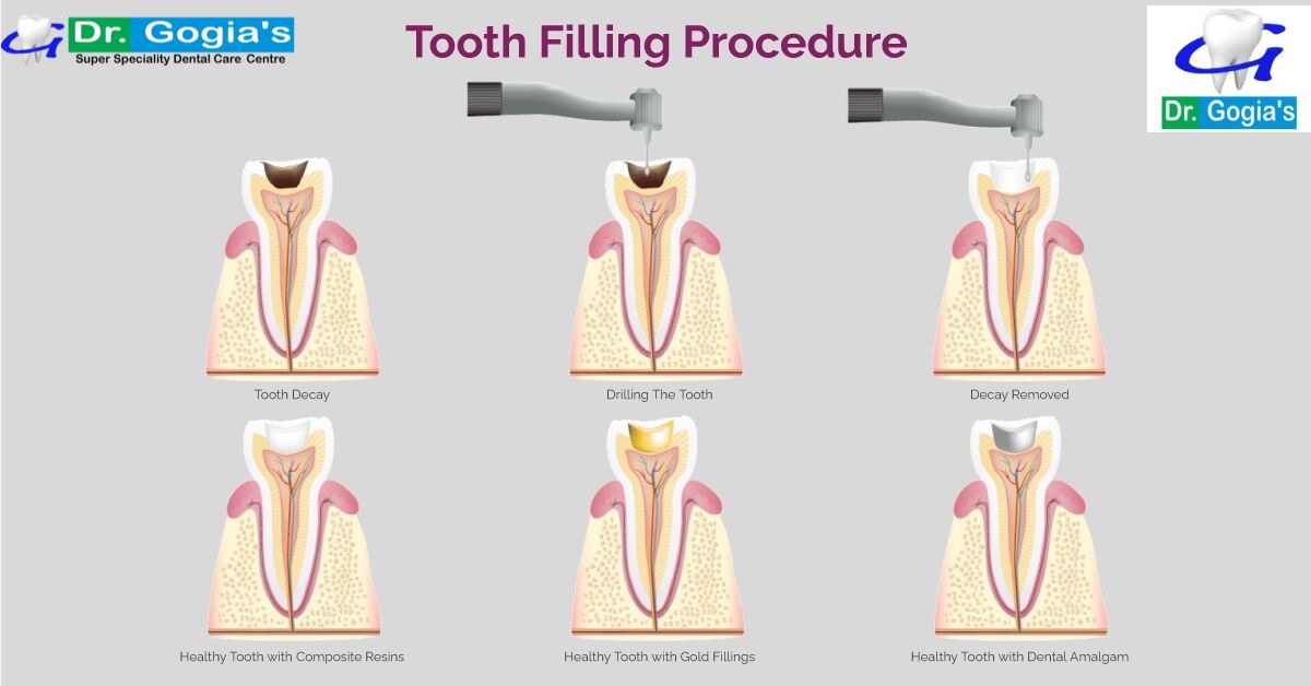 Tooth filling procedure at Dr. Gogia's Super Specialty Dental Care Centre – safe, effective, and painless solution to restore damaged teeth.
