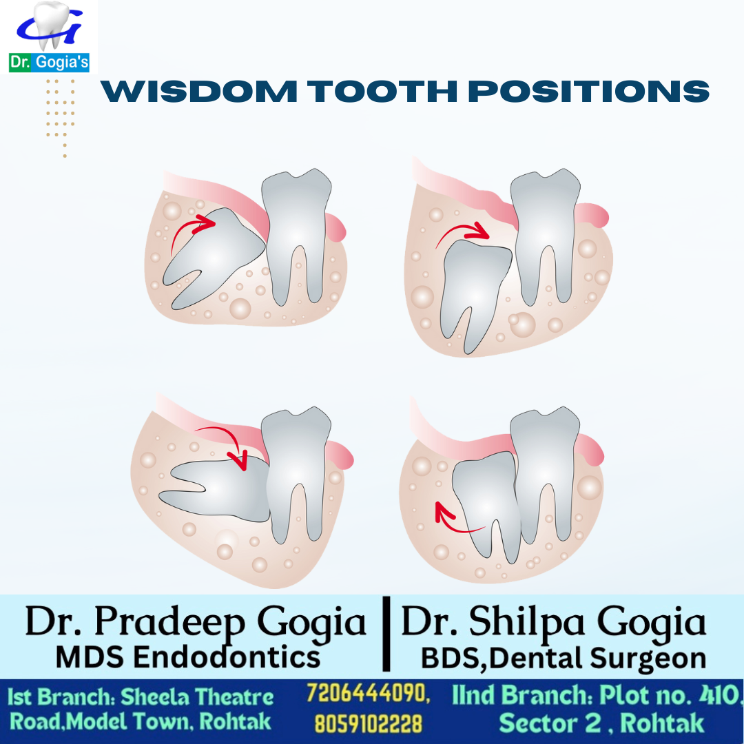 Different wisdom tooth positions – vertical, horizontal, angular, and impacted explained by Dr. Gogia’s Dental Clinic Rohtak
