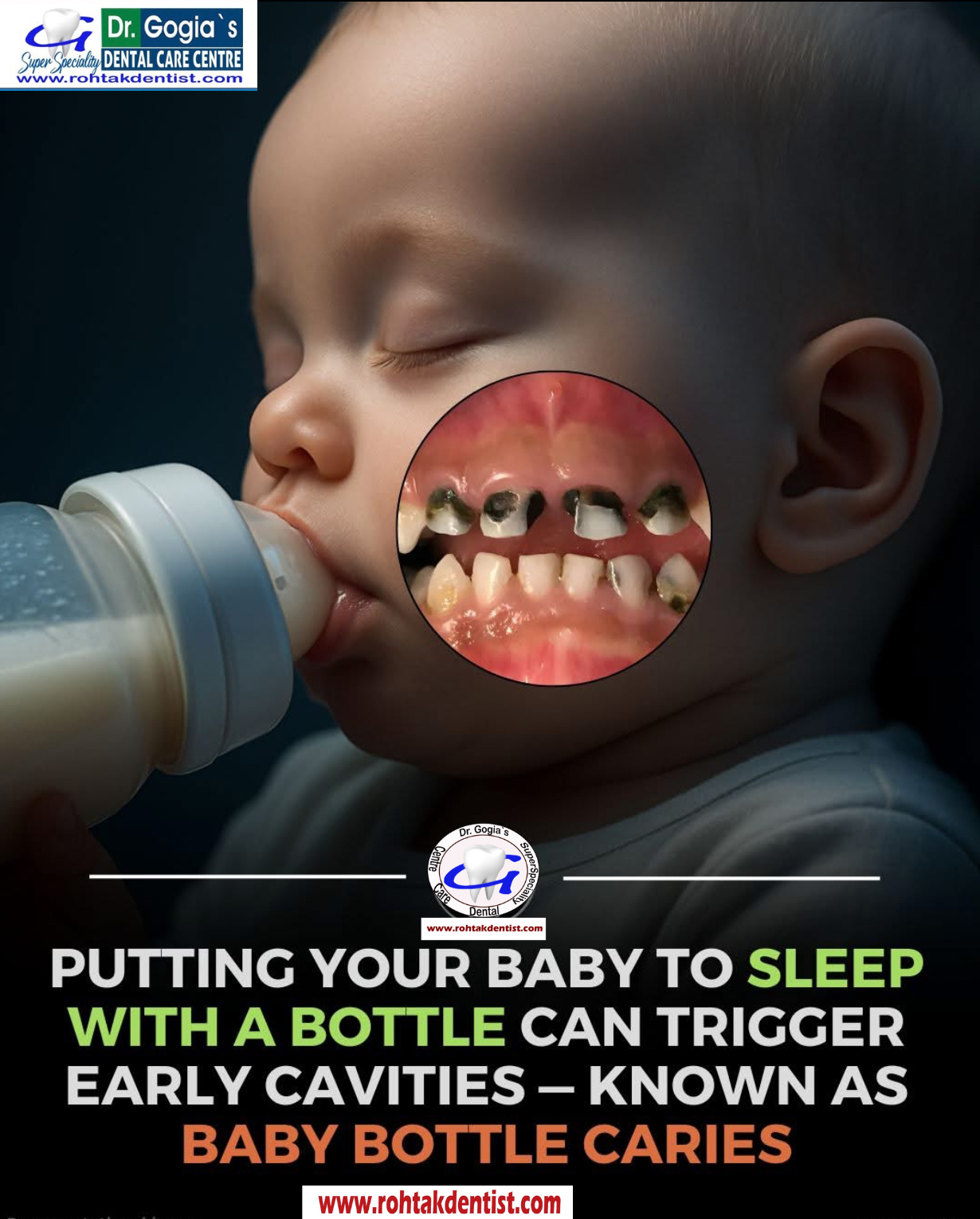 Baby Bottle Caries prevention for children’s healthy teeth