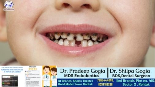 Rohtak mein Bachchon ke Black Teeth ka Ilaaj – Kids Dental Care Kids Black Teeth Treatment in Rohtak by Dr. Gogia