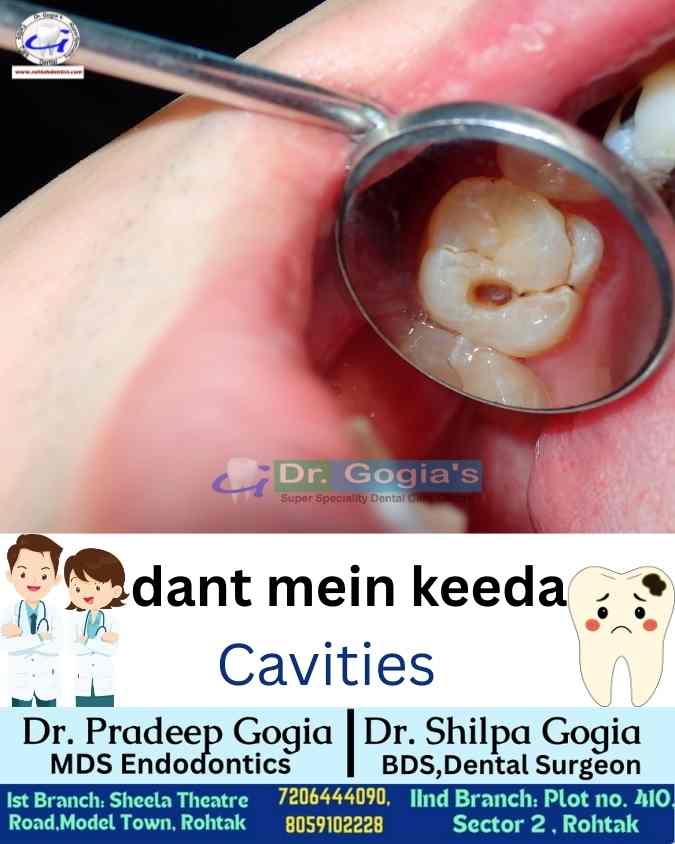 Daant mein keeda ka treatment in Rohtak – cavity filling by Dr. Gogia
