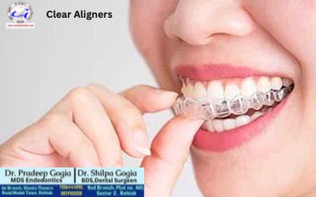 Smile makeover with Clear Aligners at Dr. Gogia’s Dental Clinic