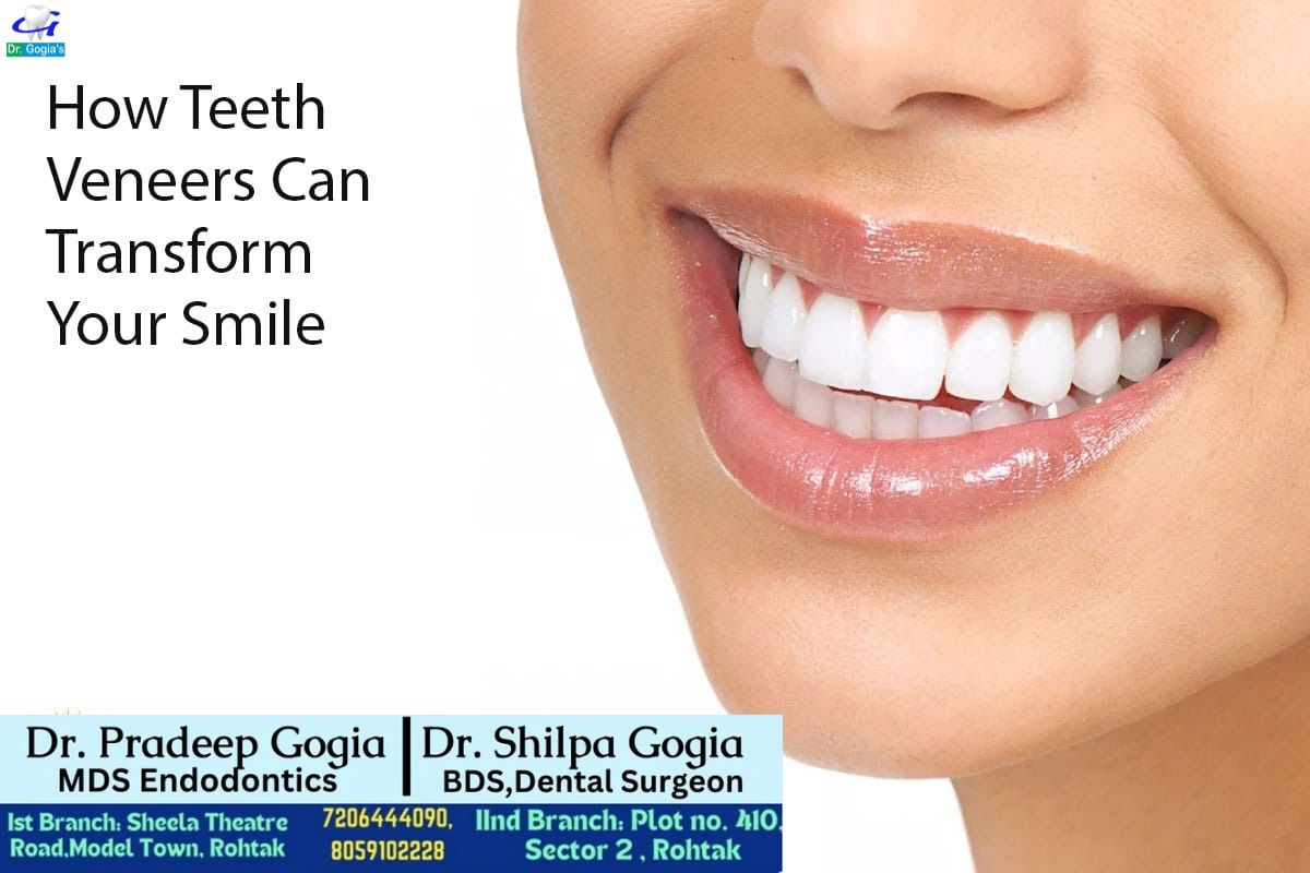 Dental Veneers at Dr. Gogia’s Super Specialty Dental Care Centre enhancing smile aesthetics and restoring confidence