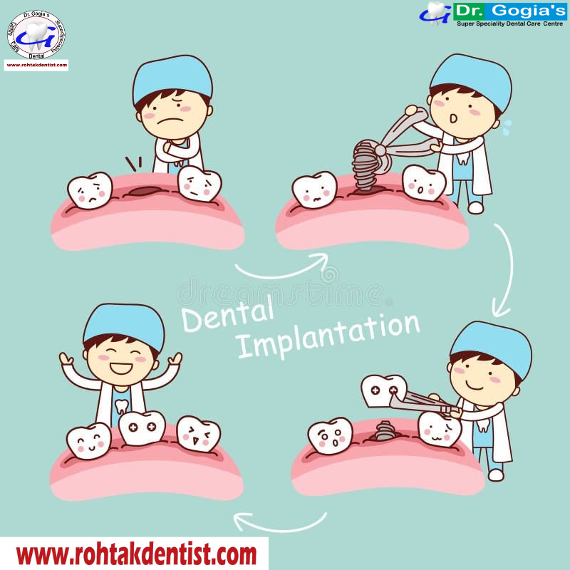 Dental implant treatment at Dr. Gogia’s Super Specialty Dental Care Centre in Rohtak