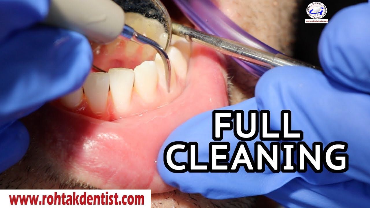 Full dental cleaning procedure at Dr. Gogia’s Super Specialty Dental Care Centre in Rohtak