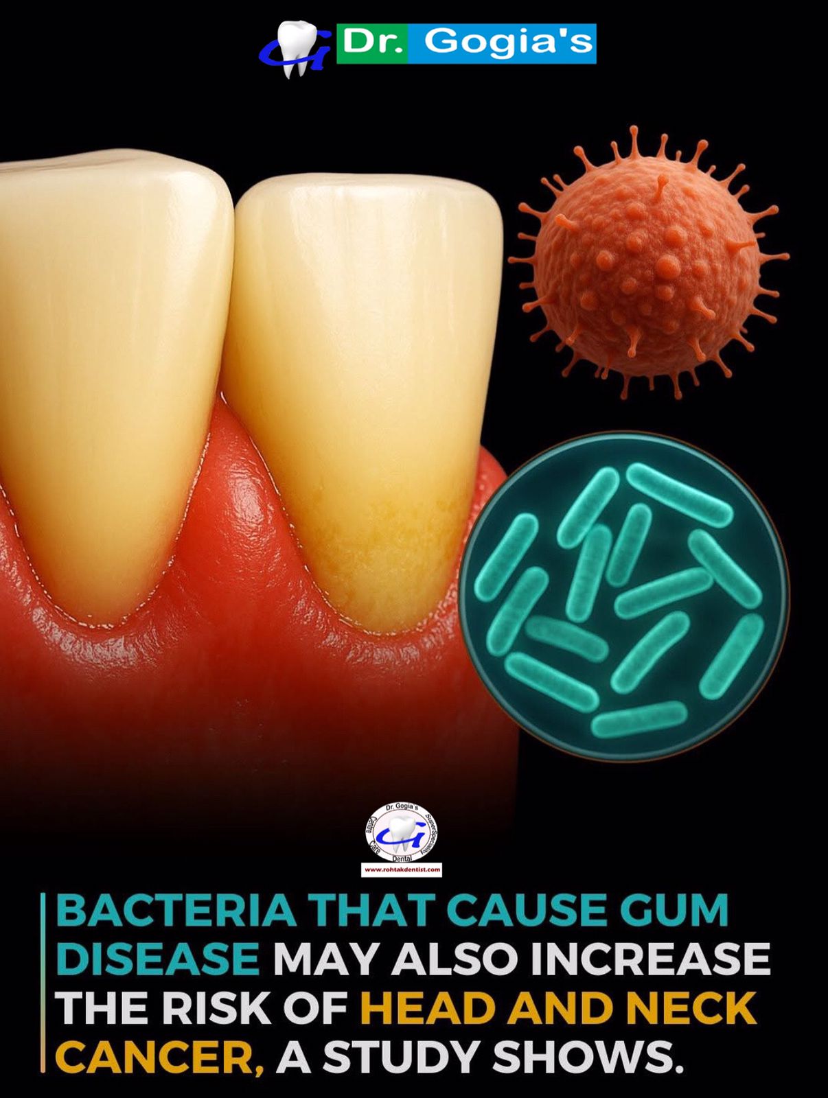 Gum Disease treatment in Rohtak at Dr. Gogia’s Dental Care