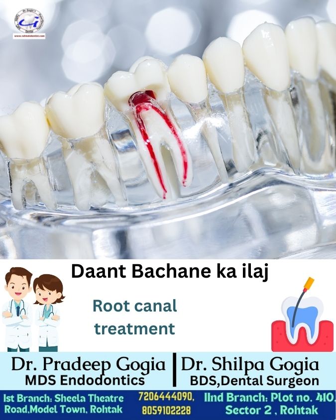 Daant Bachane Ka Ilaj Rohtak – Painless Root Canal Treatment by Dr. Gogia