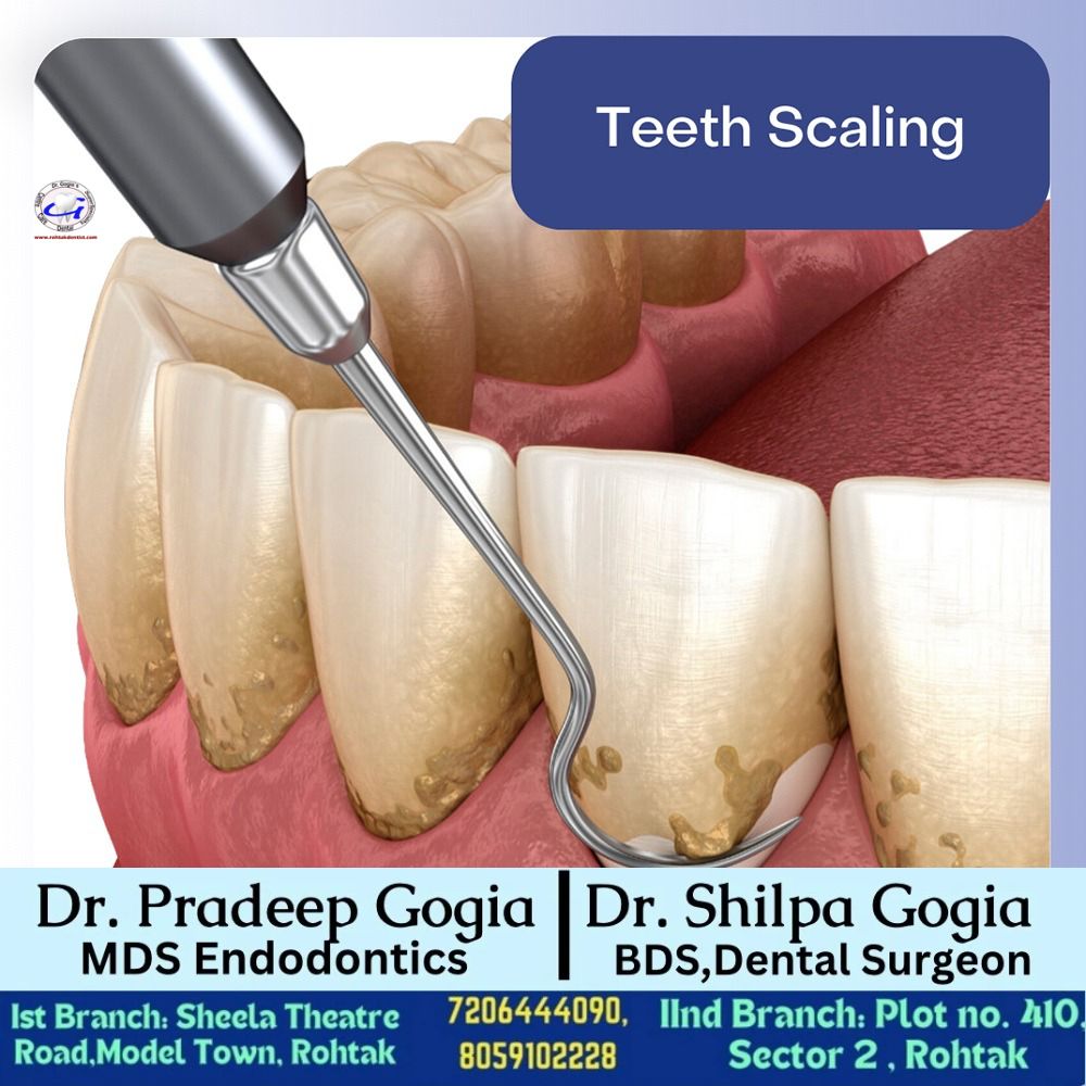 Teeth Scaling: Danton ki Safai aur Healthy Smile Ka Raaz