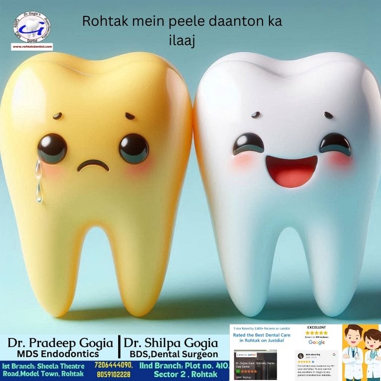 Peele Daant ka Ilaaj Rohtak – Teeth Whitening by Dr. Gogia Peele Daant ka Ilaaj Rohtak mein – Professional Teeth Whitening