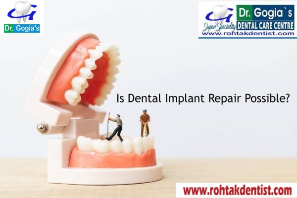 Close-up of dental implant repair procedure for a patient