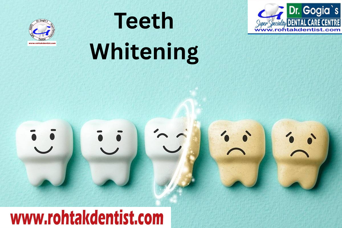 Professional teeth whitening treatment at Dr. Gogia’s Super Specialty Dental Care Centre in Rohtak