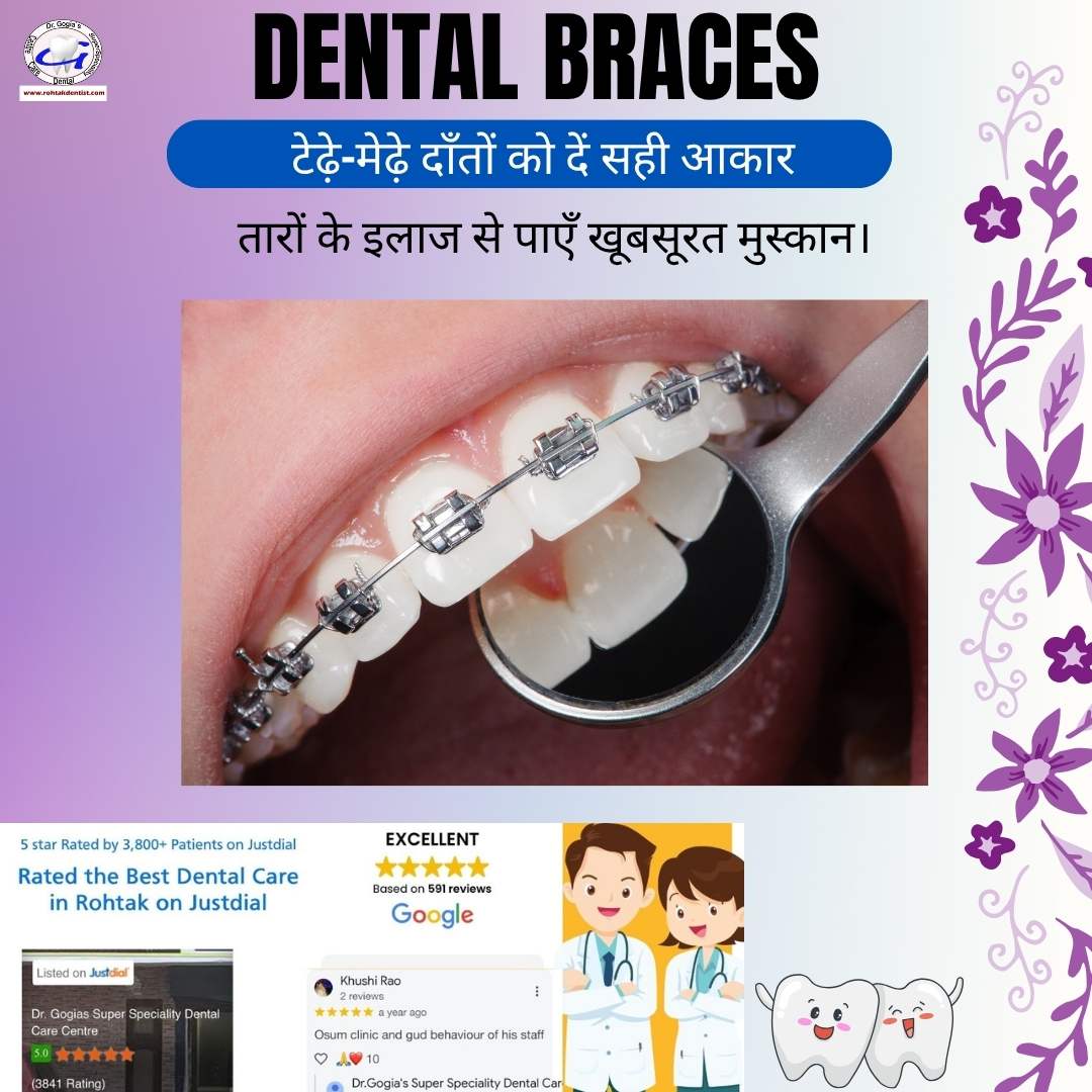 Braces treatment in Rohtak to fix crooked and misaligned teeth for a beautiful, confident smile at Dr. Gogia’s Dental Care