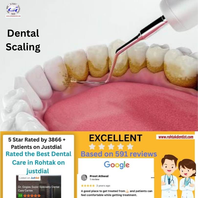 Dental Scaling Rohtak professional teeth cleaning at Dr. Gogia’s Super Specialty Dental Care Centre for healthy gums and bright smile.